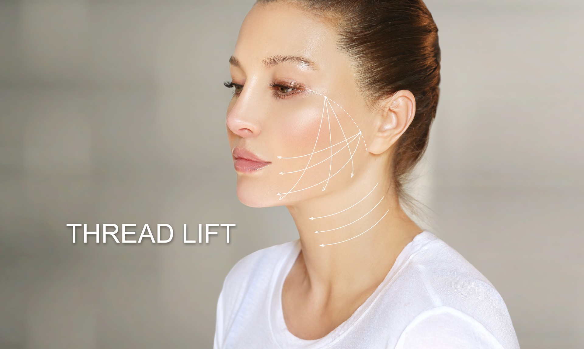 Thread Lift ,markup, thread-lift procedure for facial rejuvenation.